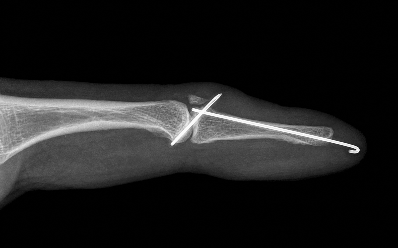 Mallet finger extension-block pinning