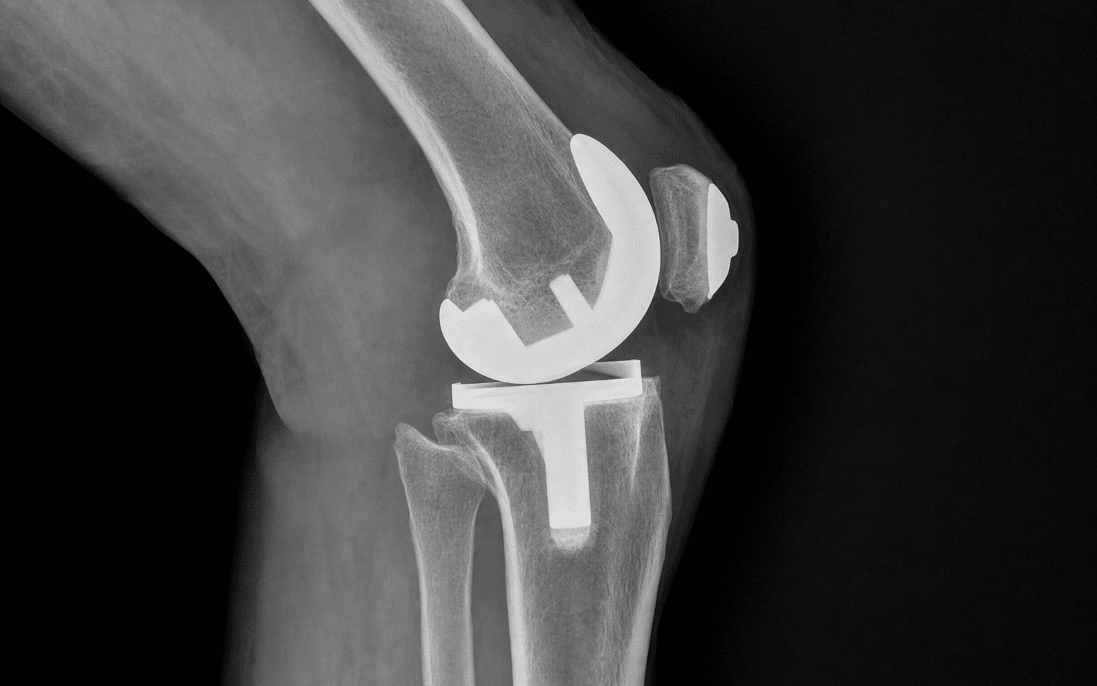 Stiff total knee arthroplasty