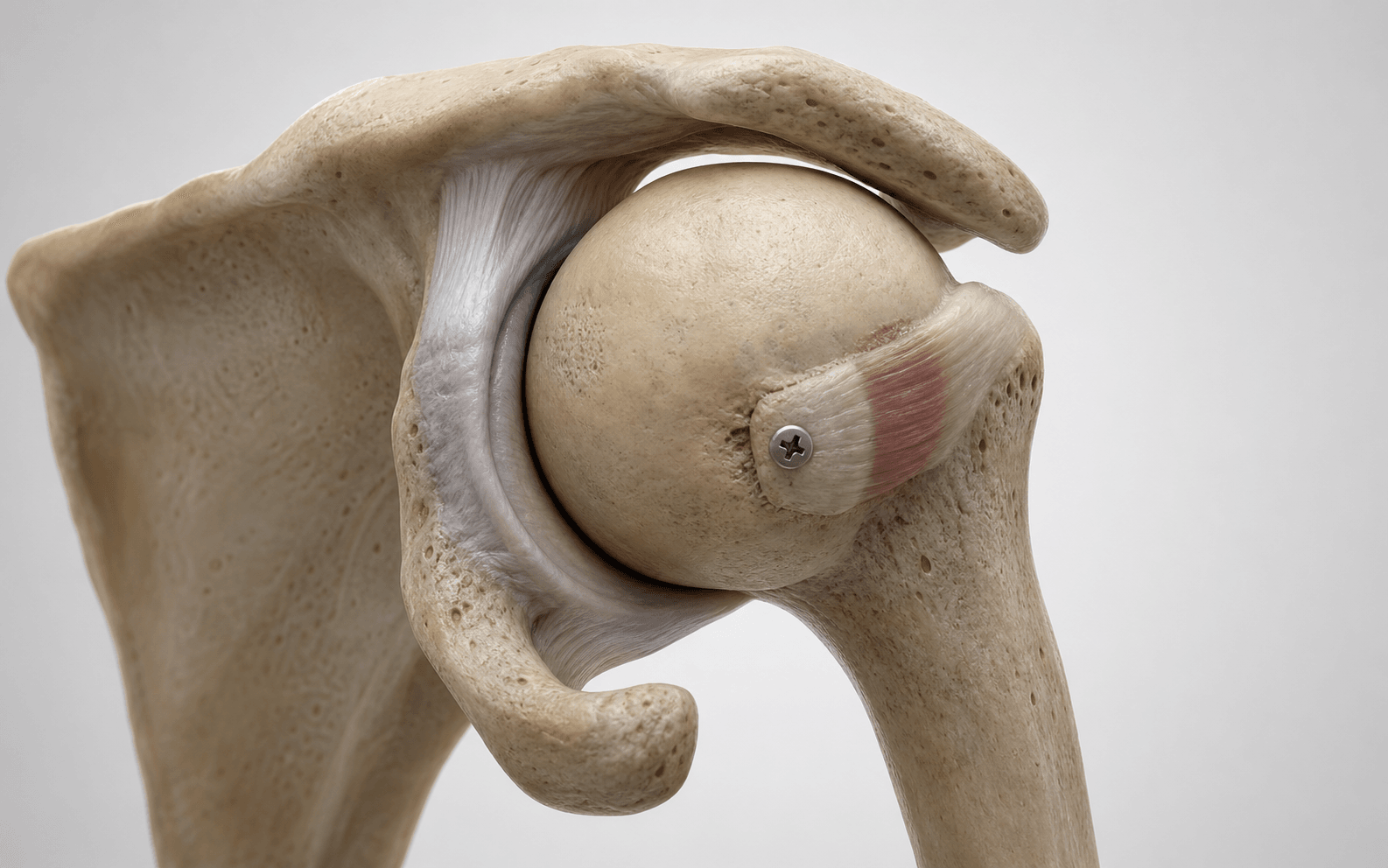 McLaughlin procedure for locked posterior shoulder dislocation