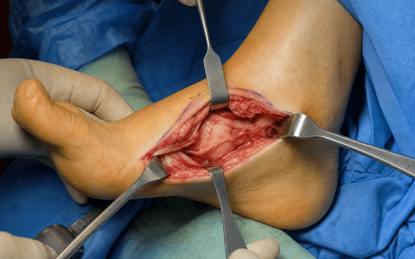 Medial talus/navicular approach