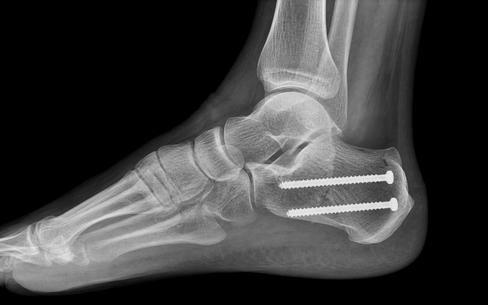 Medial displacement calcaneal osteotomy