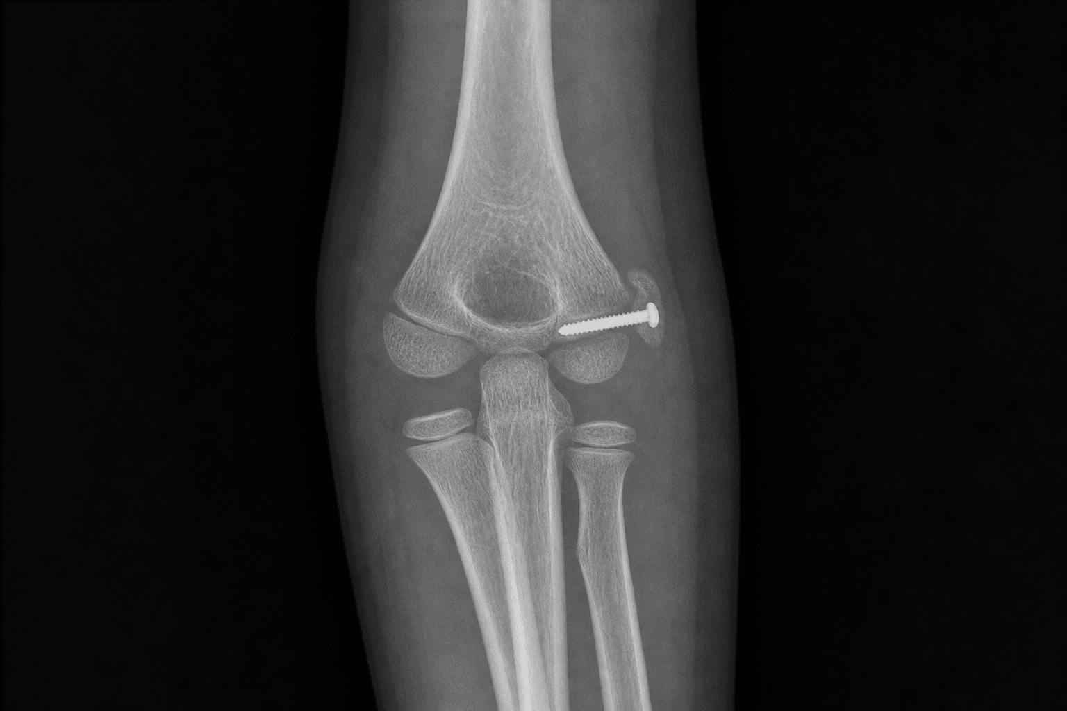 Paediatric medial epicondyle ORIF with a screw
