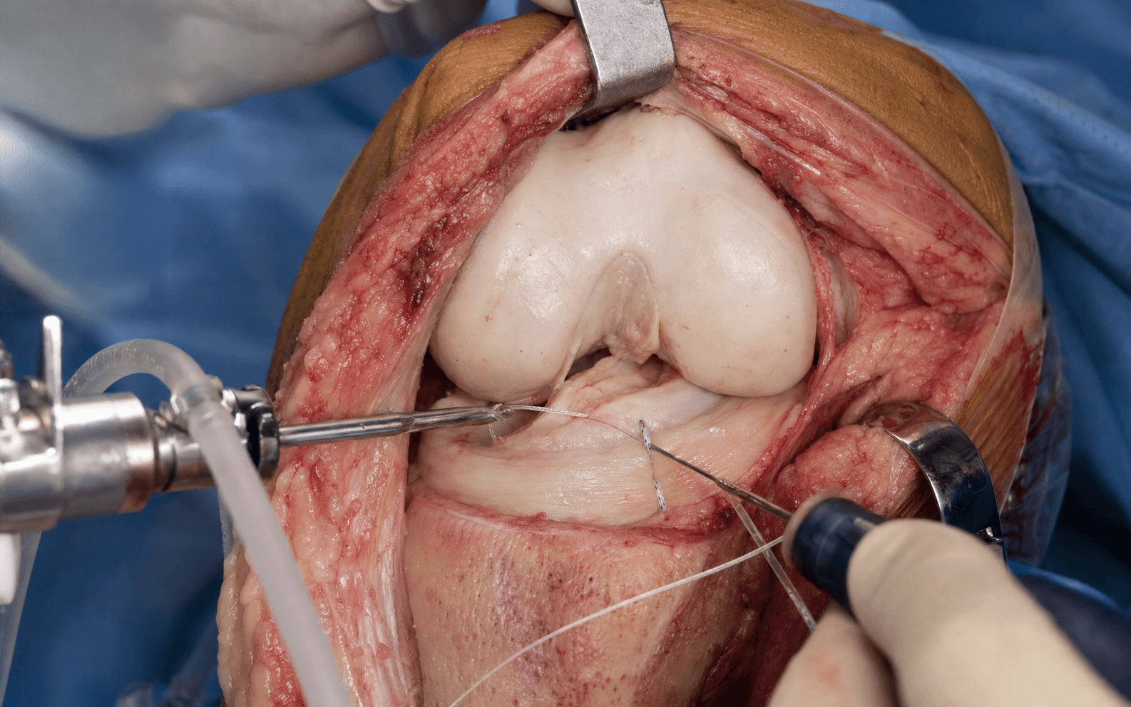 Meniscal repair