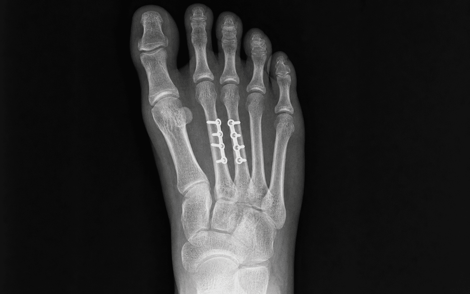 Central metatarsal ORIF