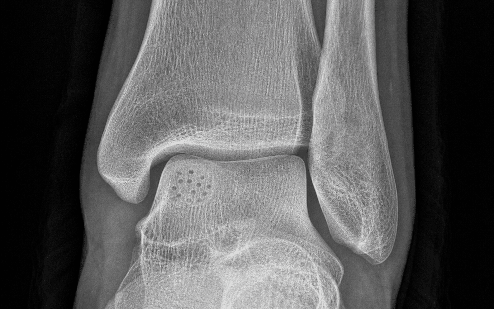 Talar dome microfracture