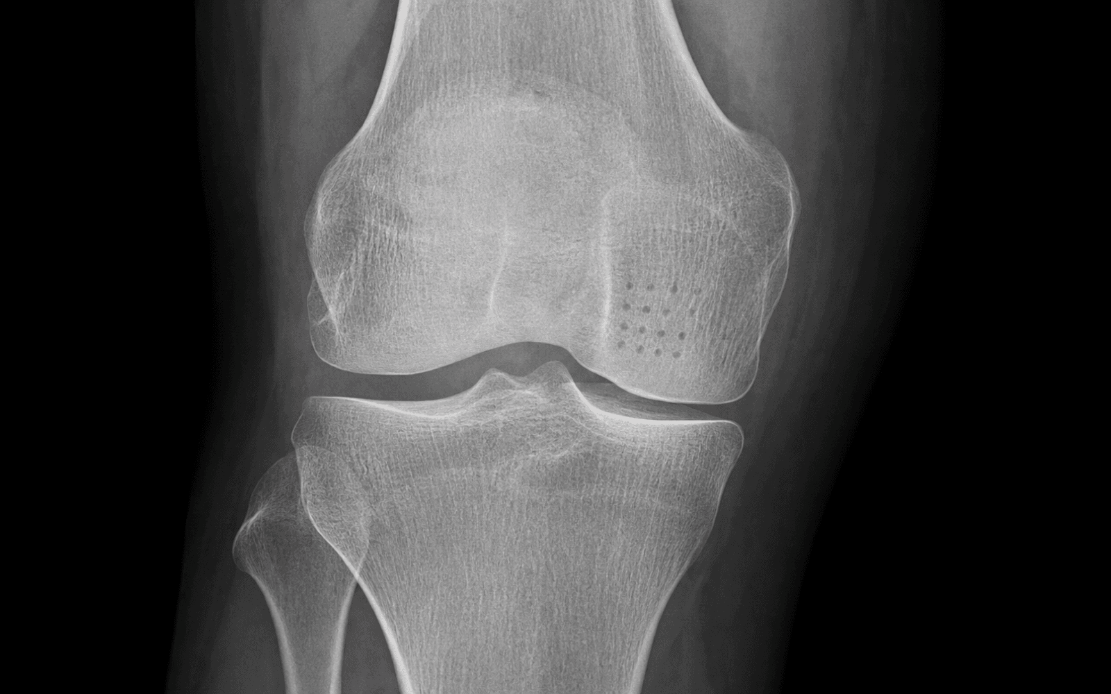 Microfracture technique