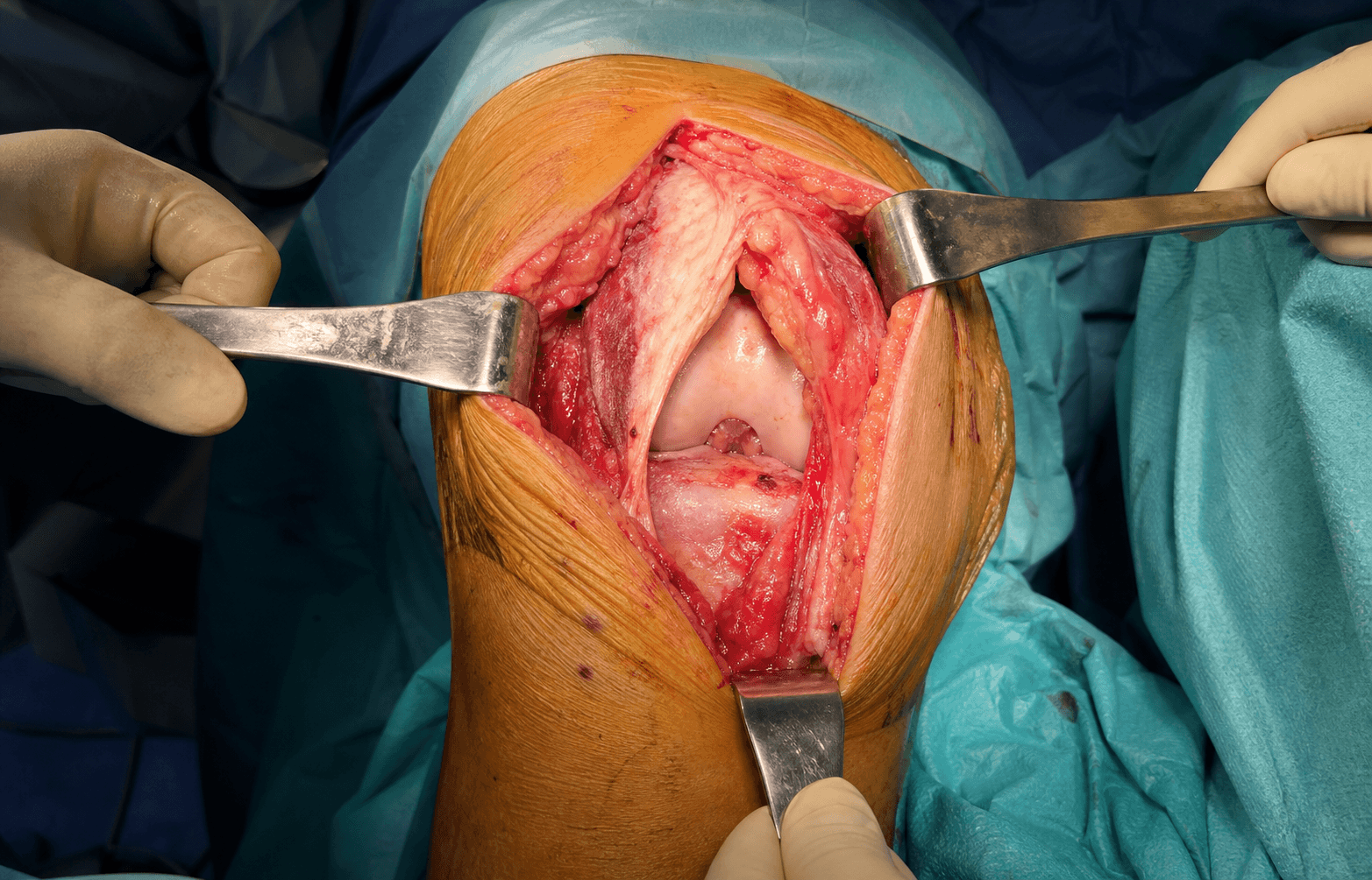 Midvastus approach