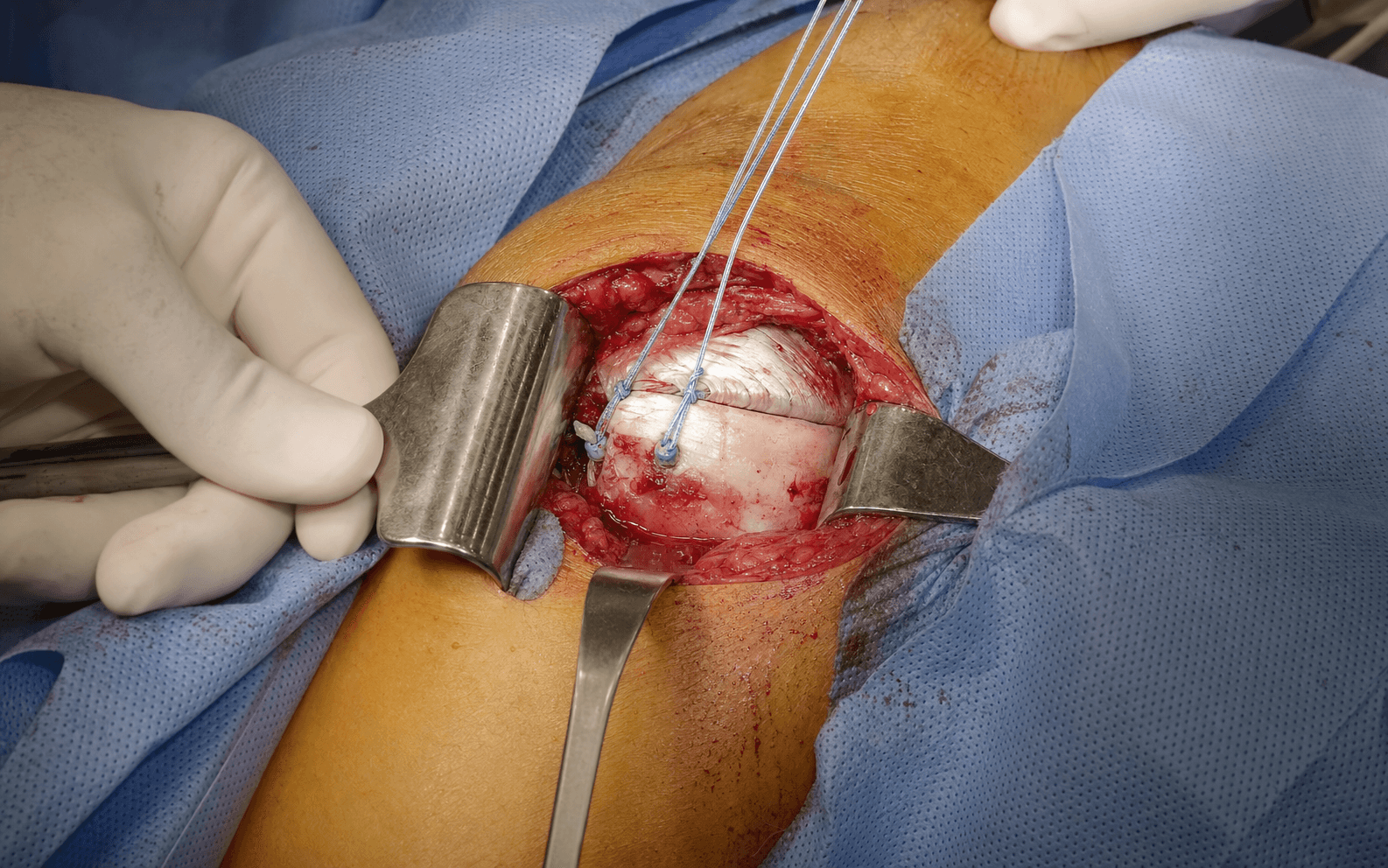 Mini-open cuff repair