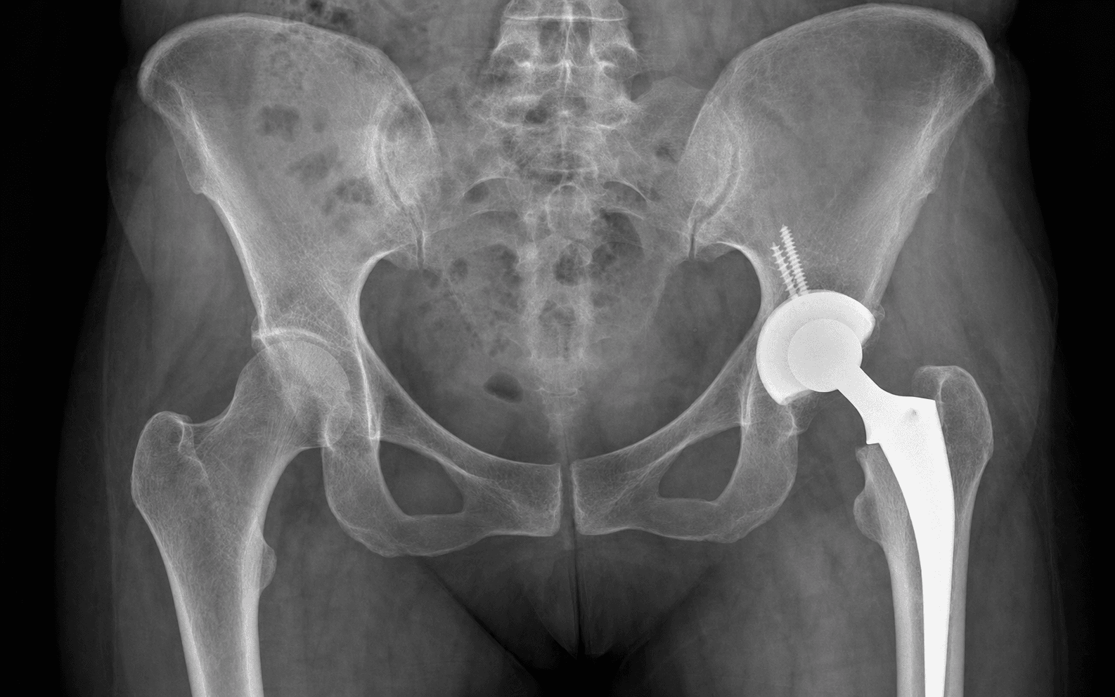 MIS posterior THA