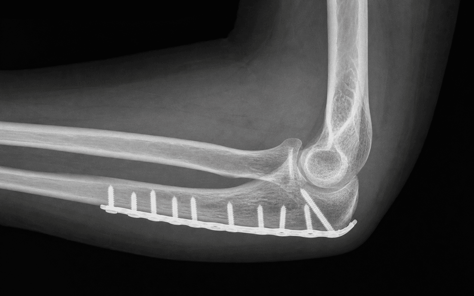 Adult Monteggia ulna plating