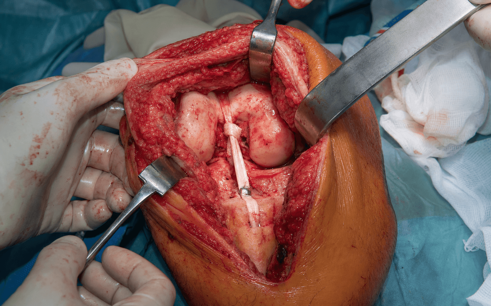 Multiligament knee reconstruction