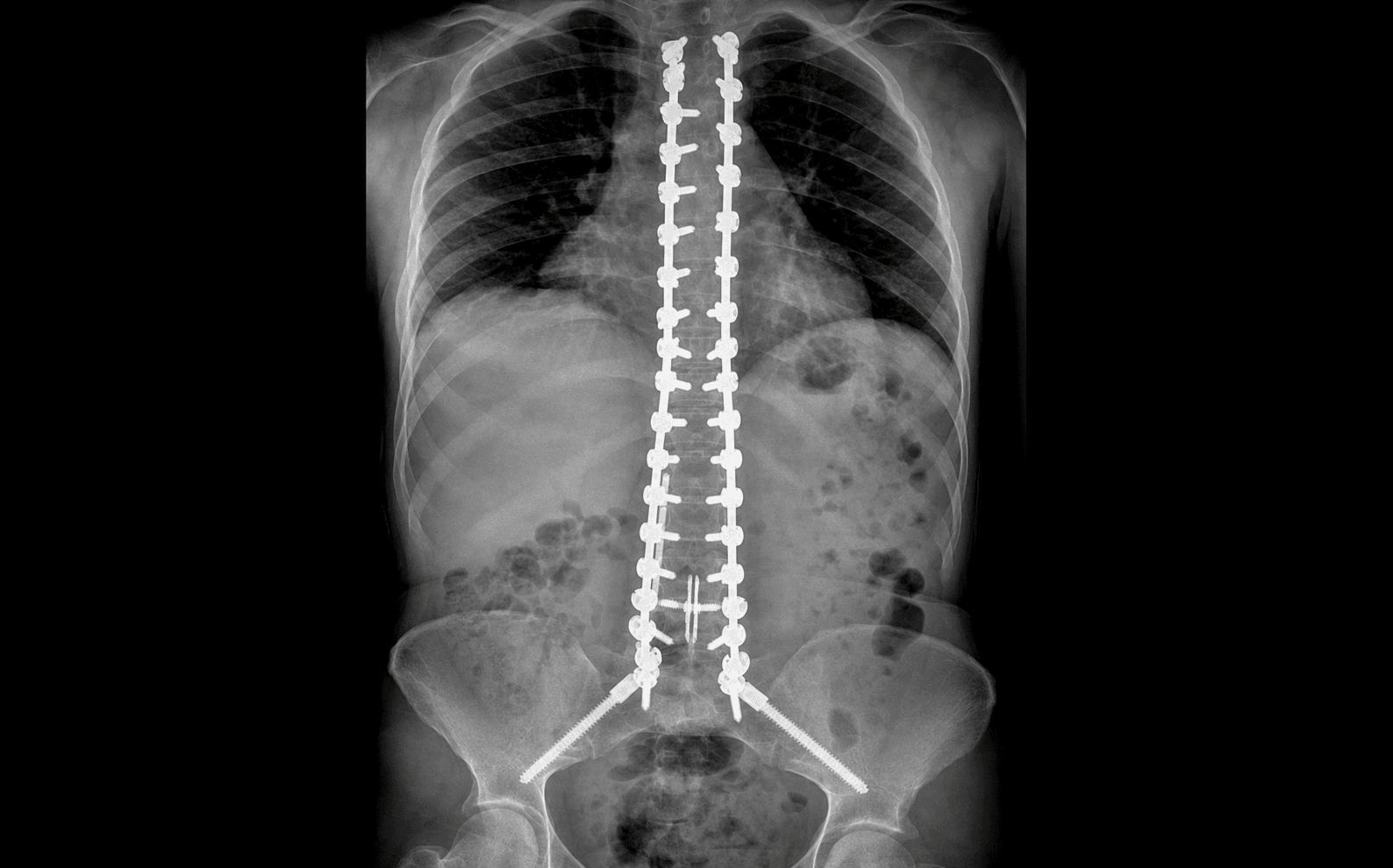 Neuromuscular scoliosis fusion