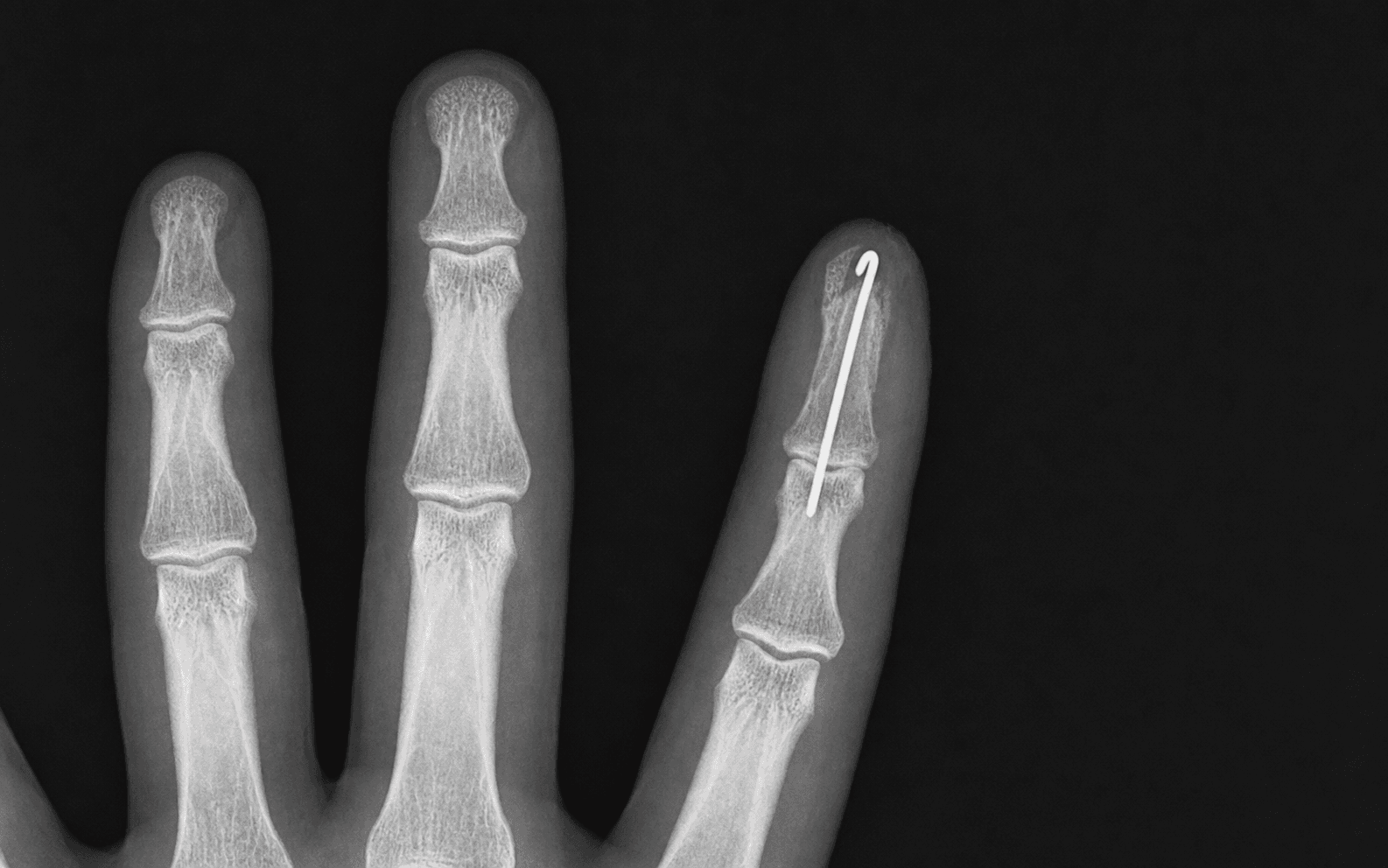 Radiograph of a fingertip injury with a pinned distal phalanx