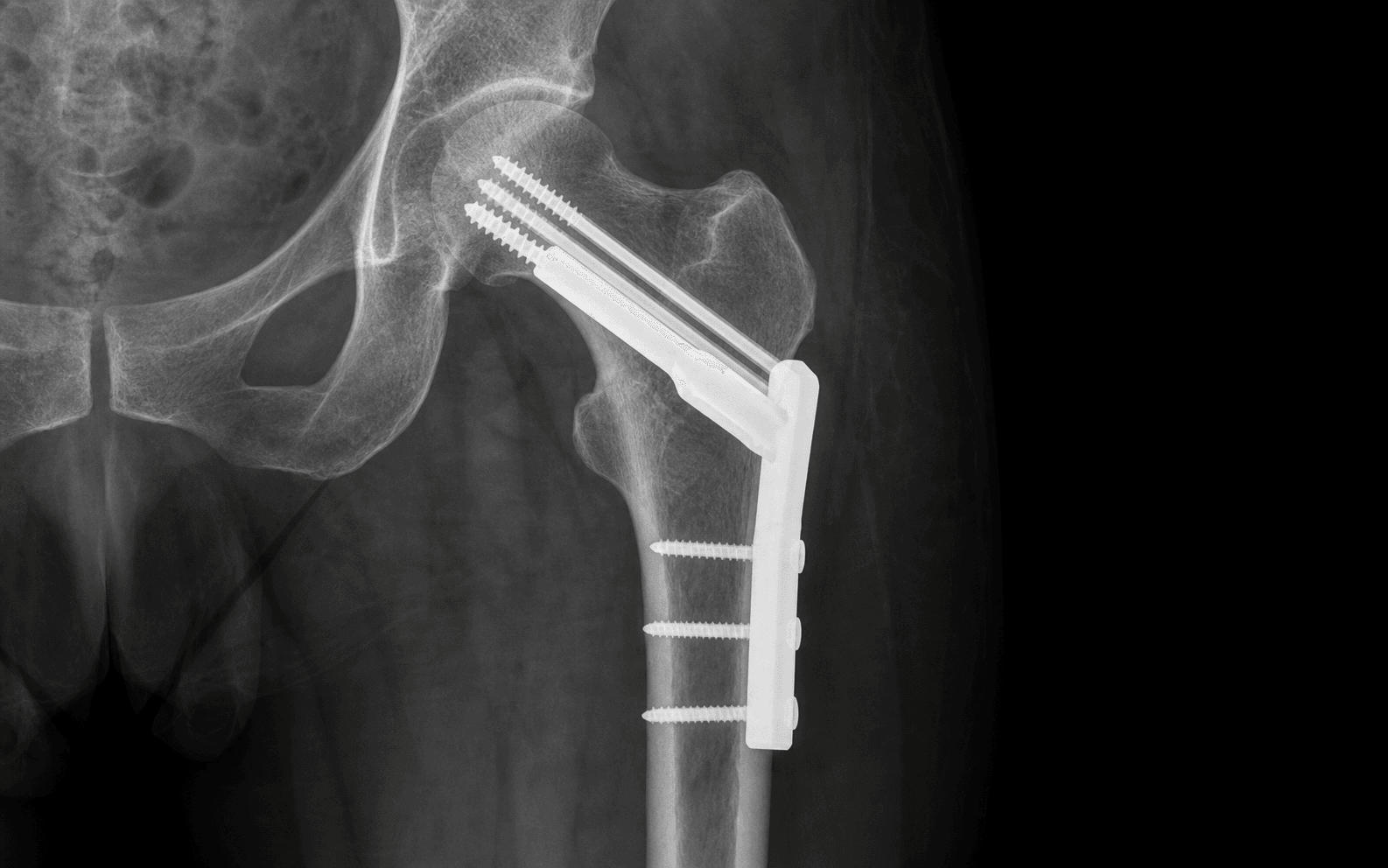 NOF fracture DHS + screw