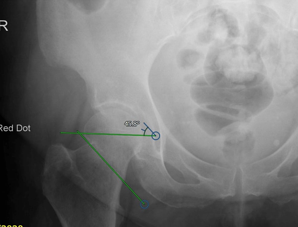 AP radiograph of a right hip with the fracture-line angle measured at 45.8 degrees to a horizontal reference