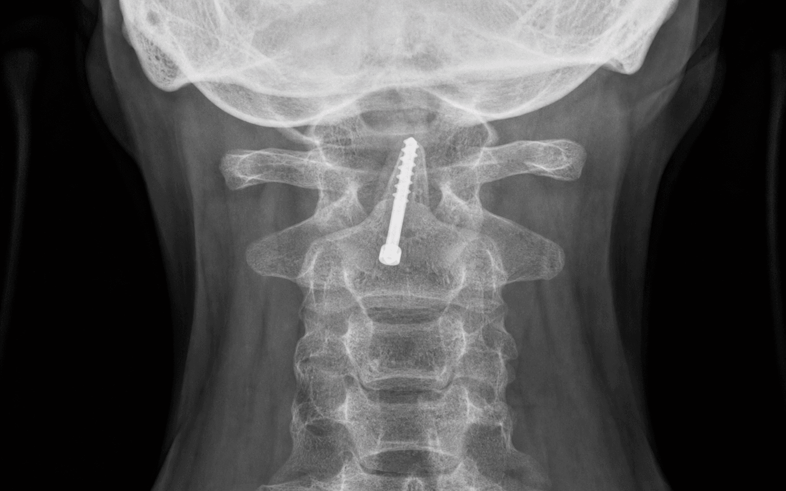 Anterior odontoid screw