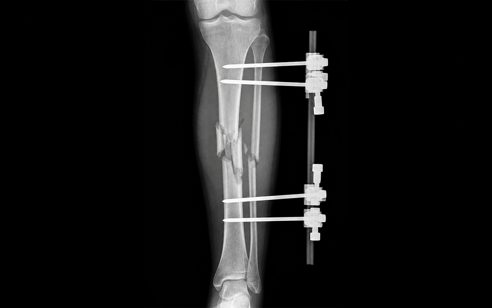 Open fracture external fixation