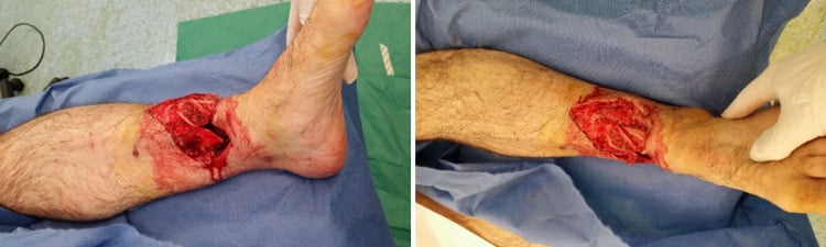 Two clinical photographs of a lower leg on blue drapes showing a distal-third wound with skin loss and exposed bone