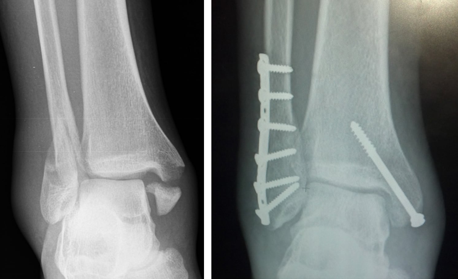 Trimalleolar ankle fracture before and after ORIF