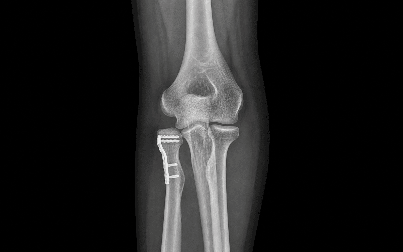 Radial head ORIF