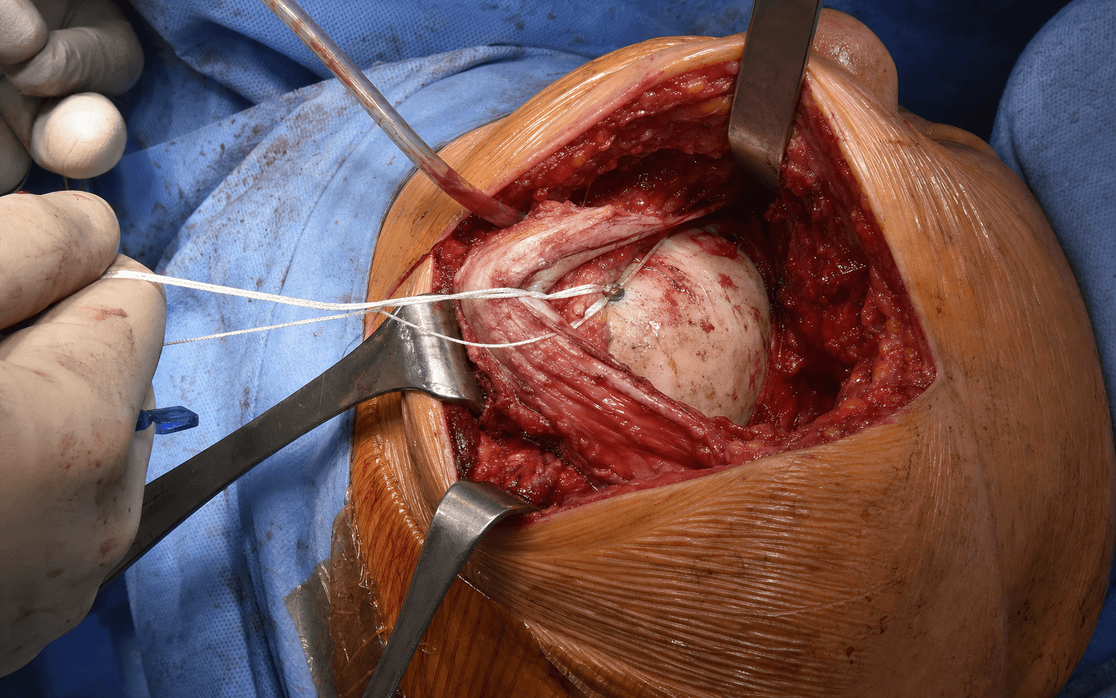 Open rotator cuff repair