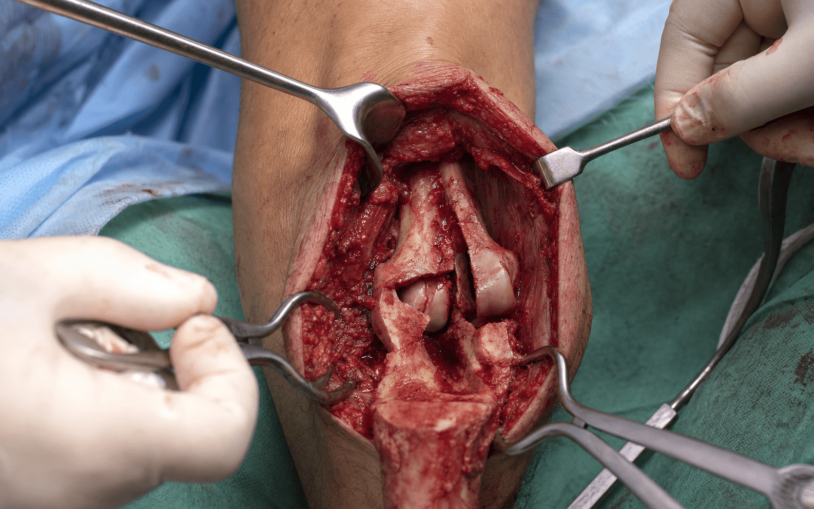 Olecranon osteotomy approach to a distal humerus fracture