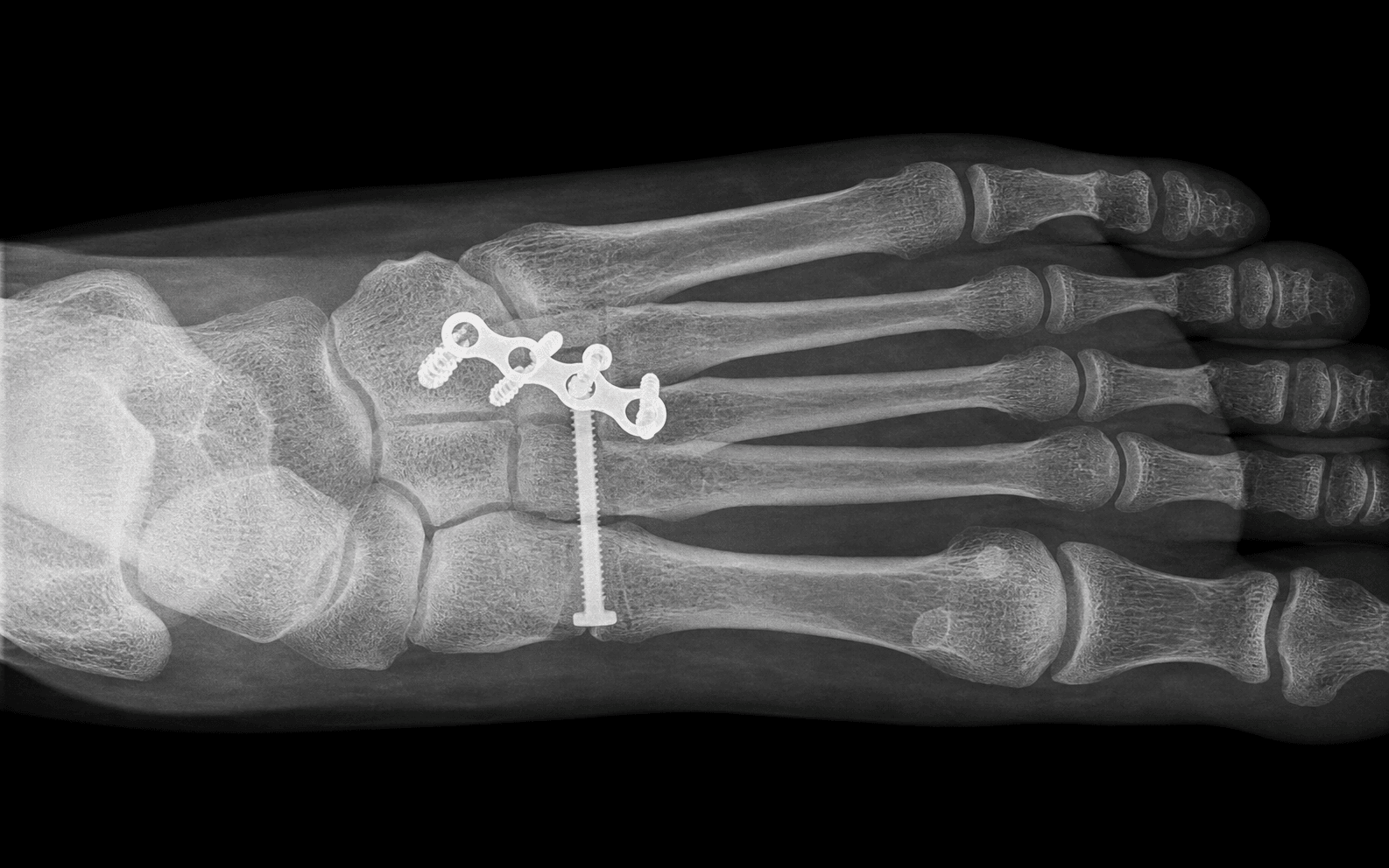 Lisfranc ORIF