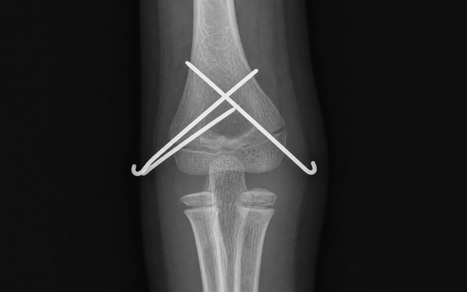 Paediatric supracondylar pinning
