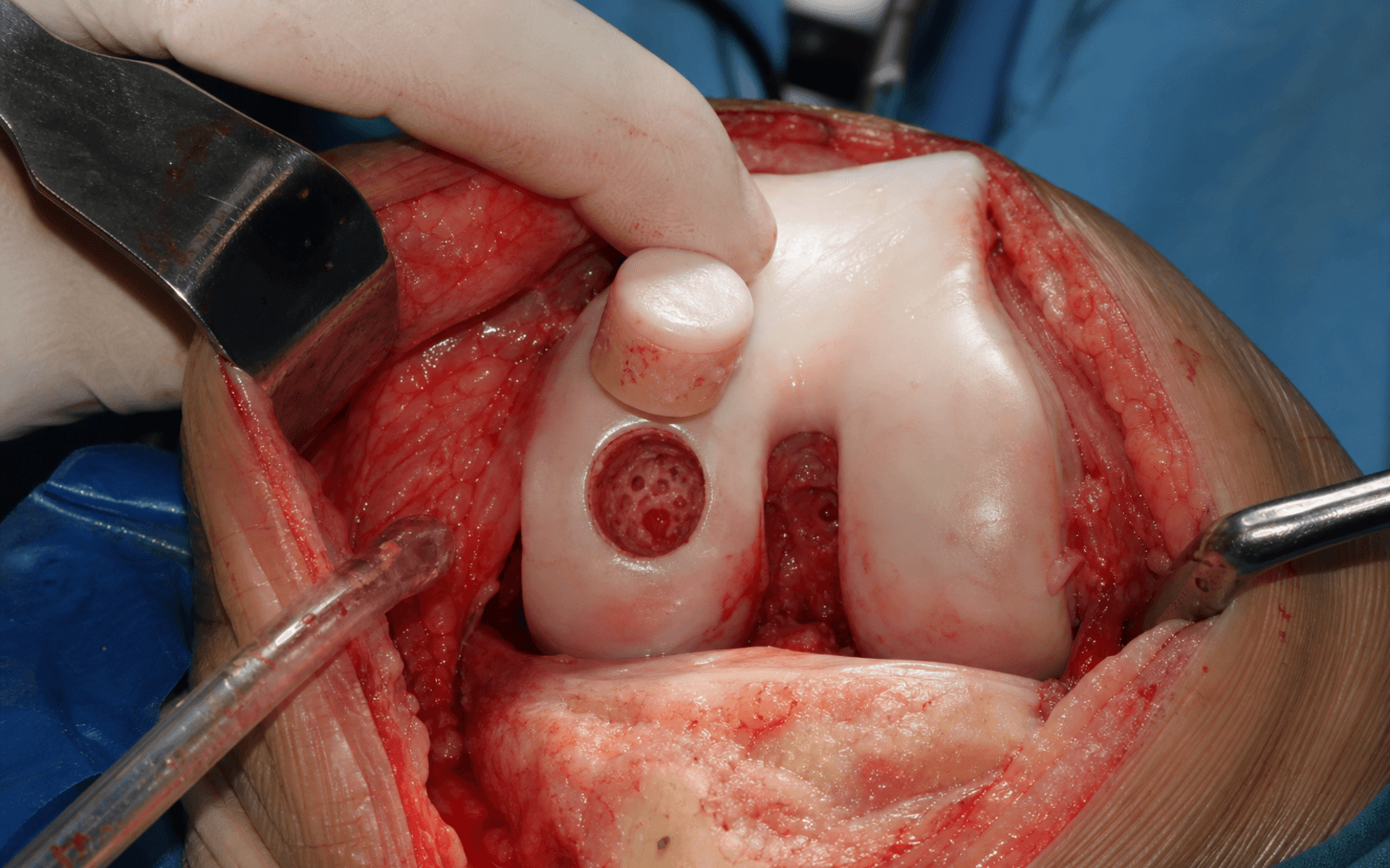 Intra-operative osteochondral allograft of the femoral condyle