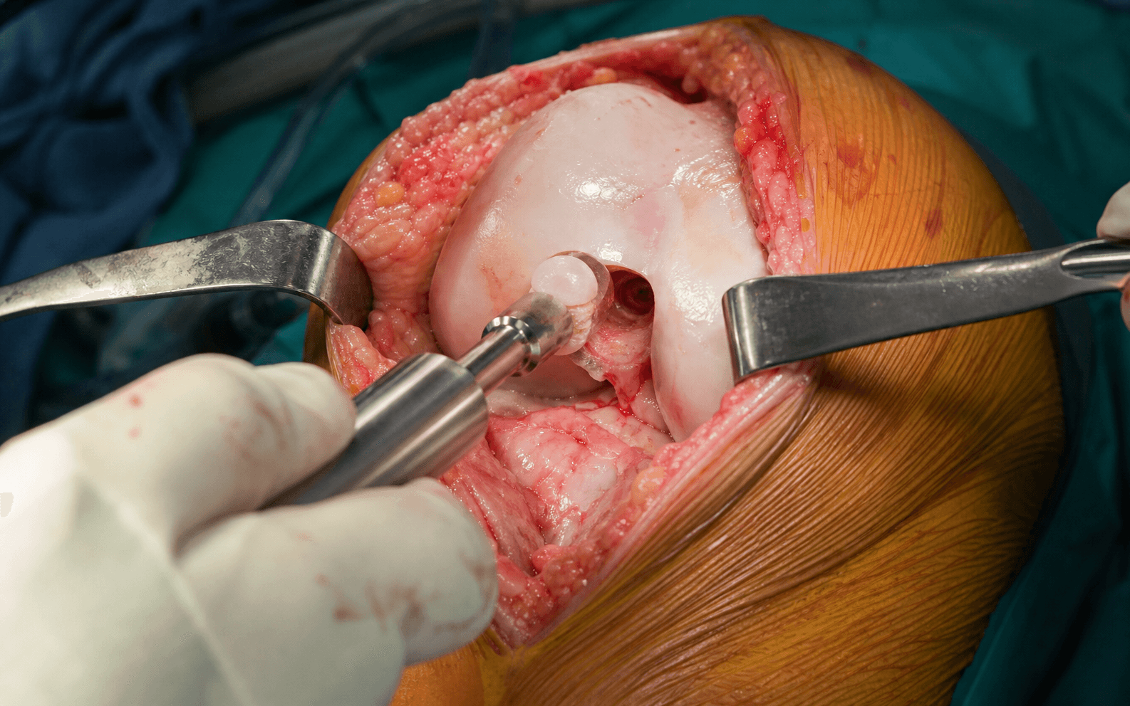 Osteochondral autograft (OATS)