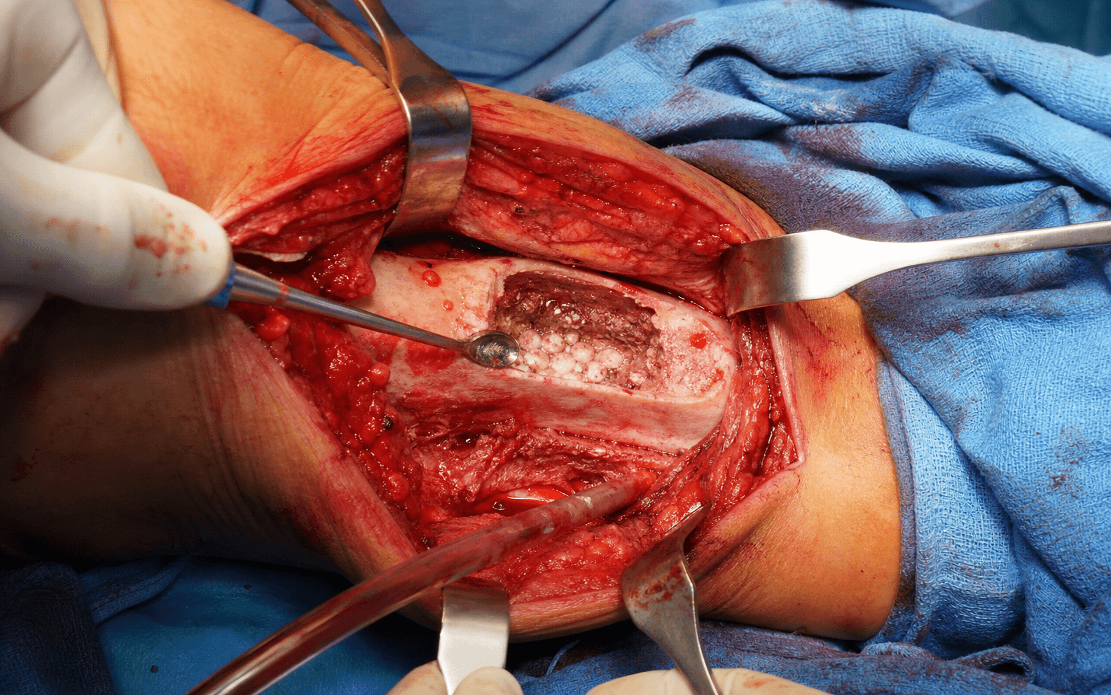 Osteomyelitis debridement
