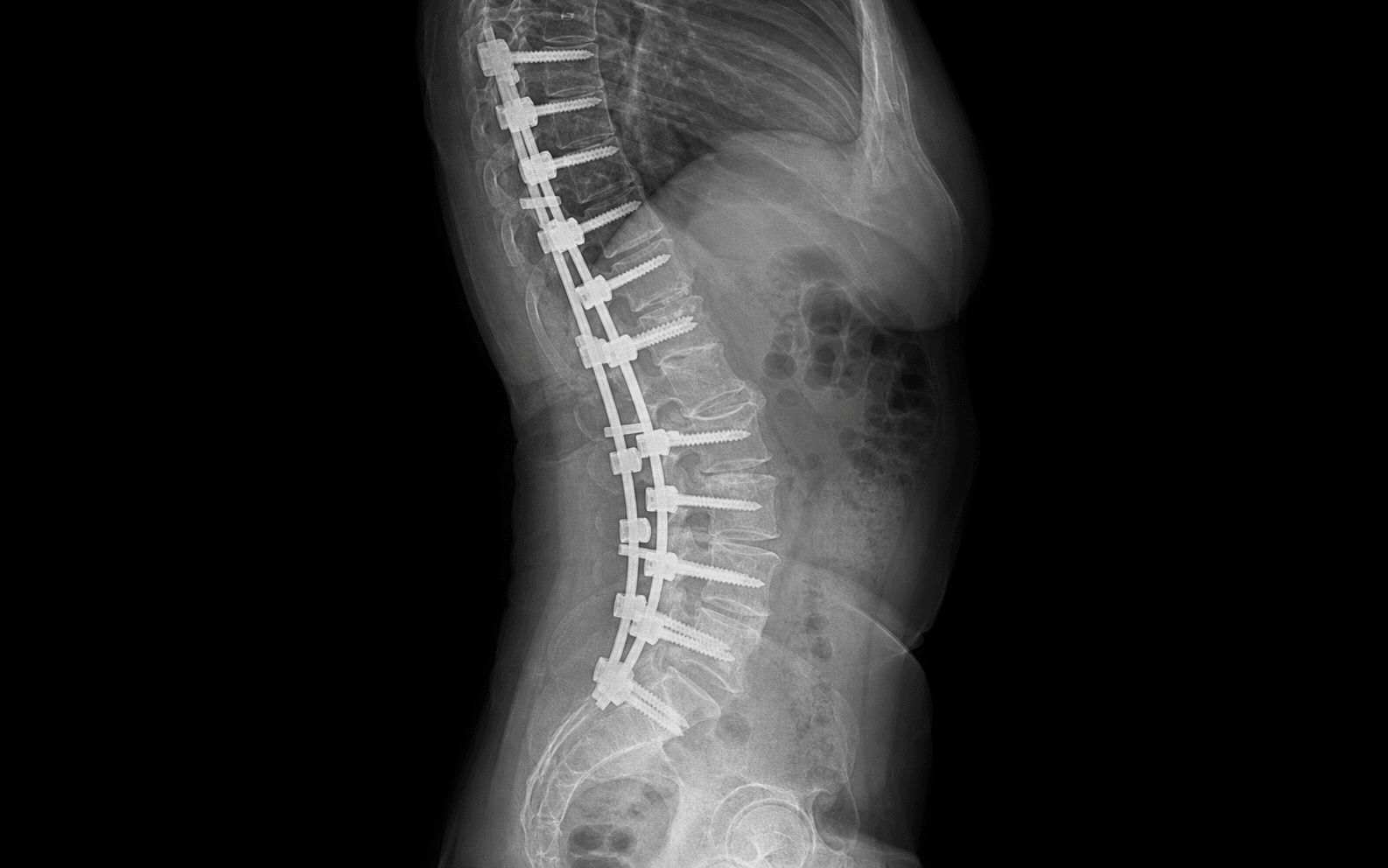 Lateral spine radiograph after a pedicle subtraction osteotomy