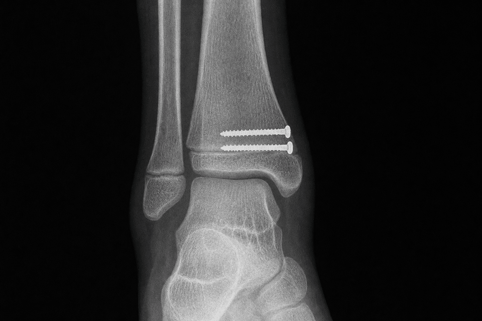 Salter-Harris ankle ORIF