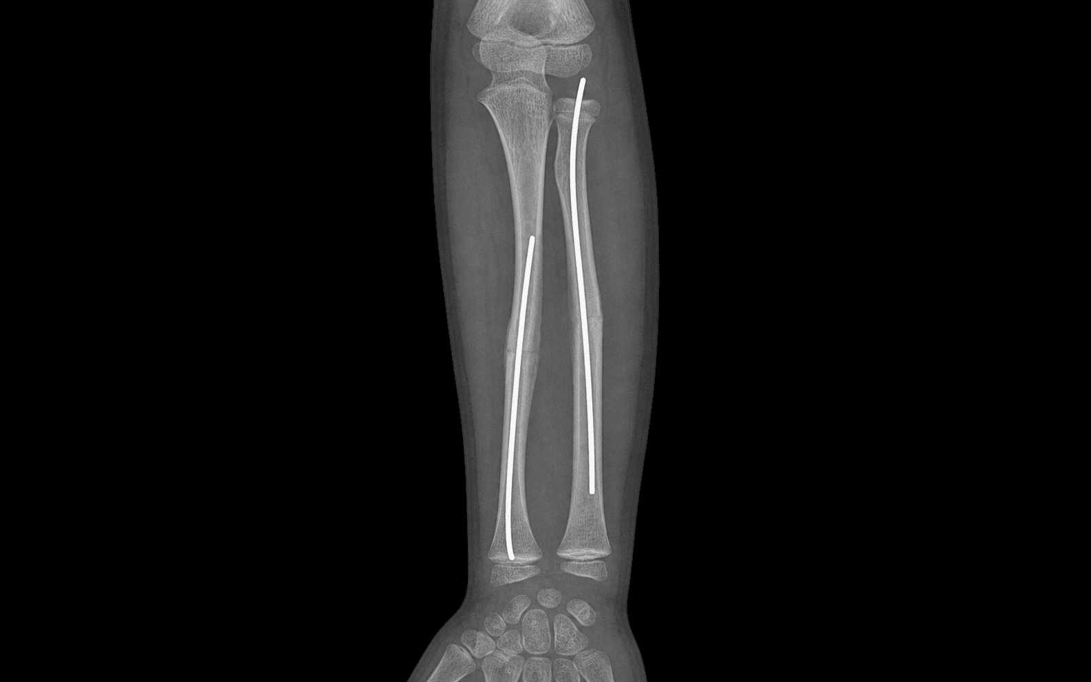 Forearm radiograph after flexible nailing of both-bone fractures