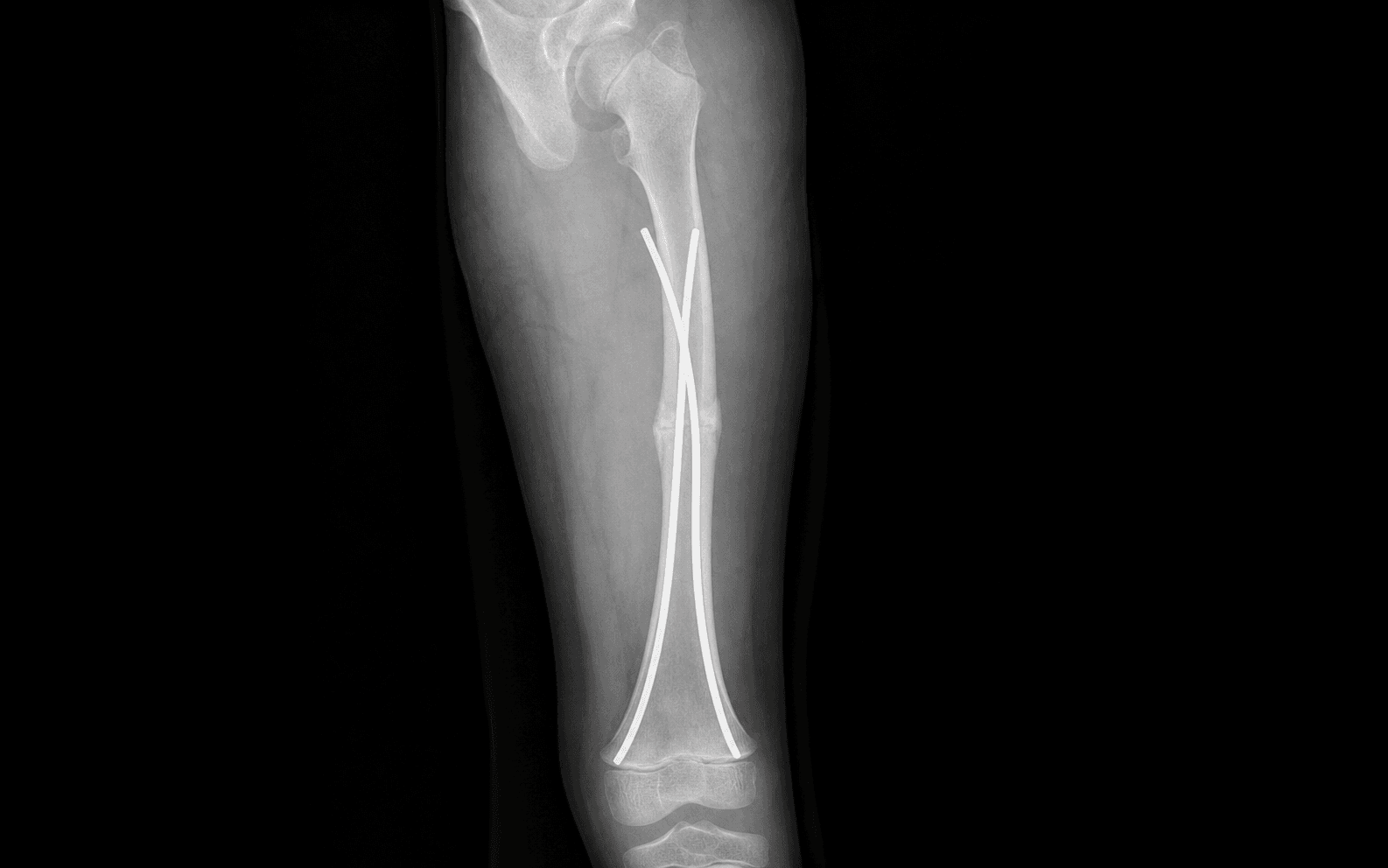 Paediatric flexible femoral nails