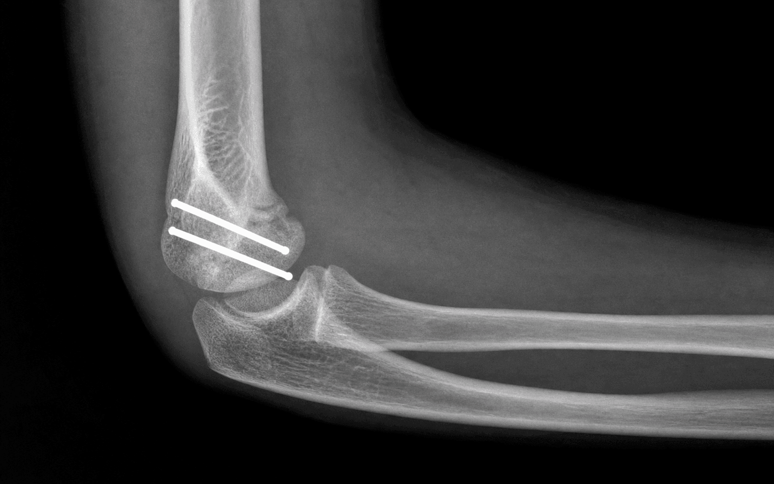 Paediatric lateral condyle ORIF
