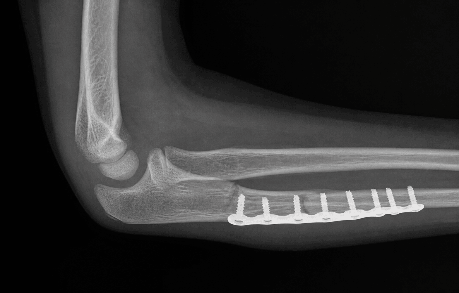 Paediatric Monteggia ORIF