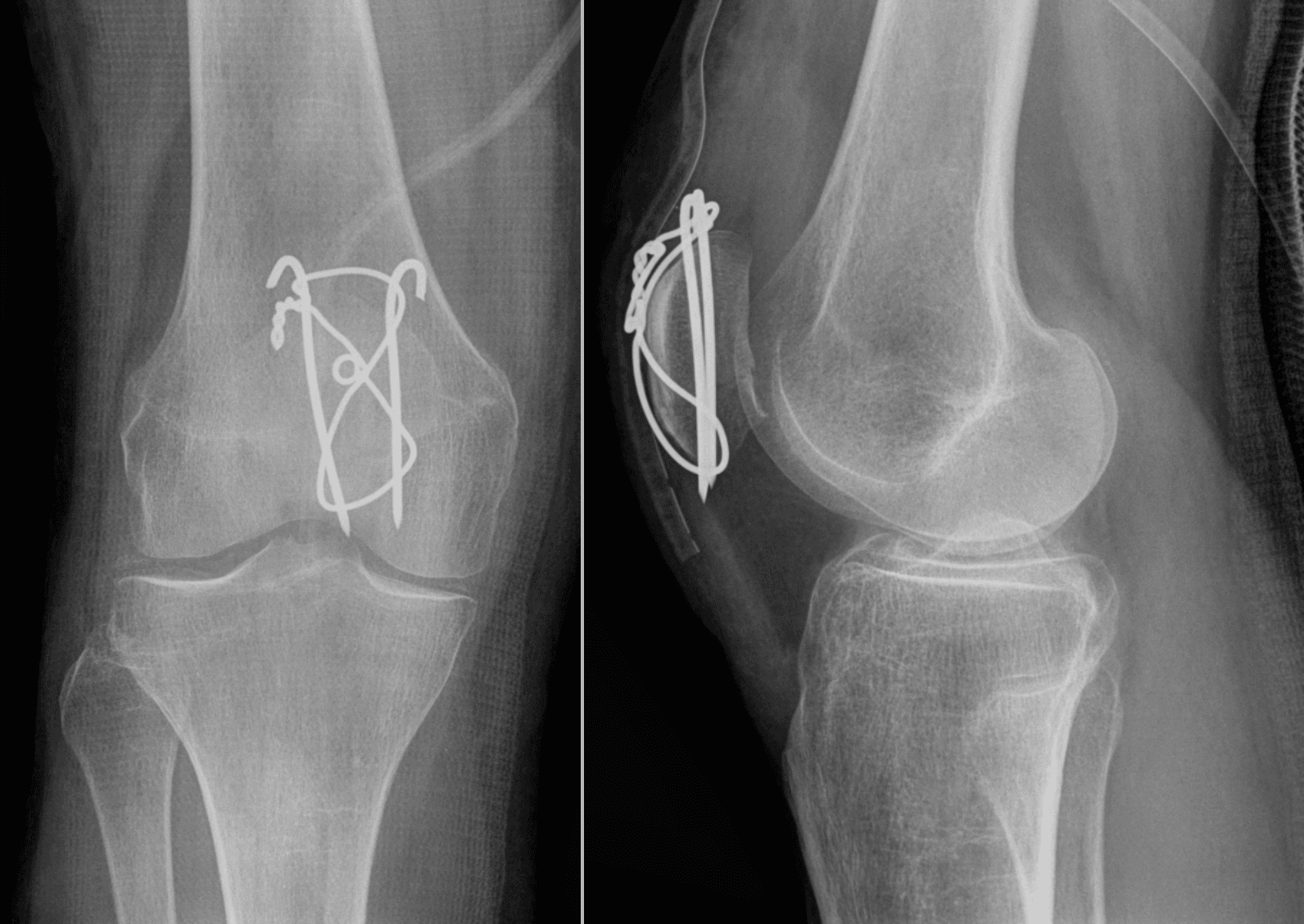 Transverse patella fracture fixed with tension-band wiring