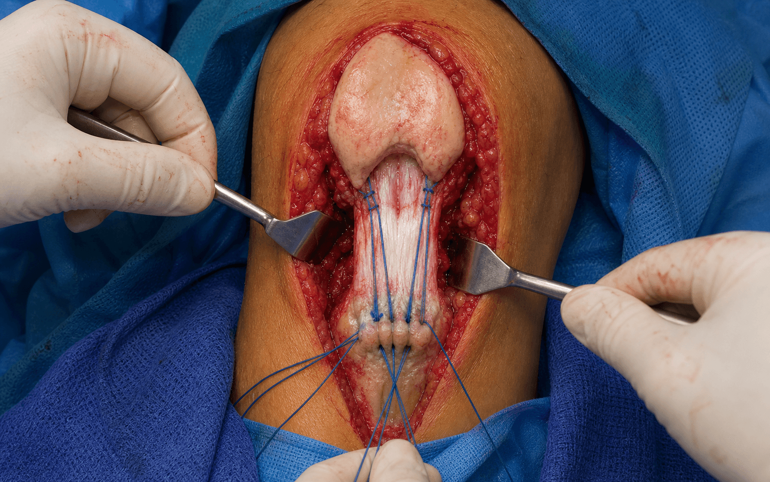 Patellar tendon repair