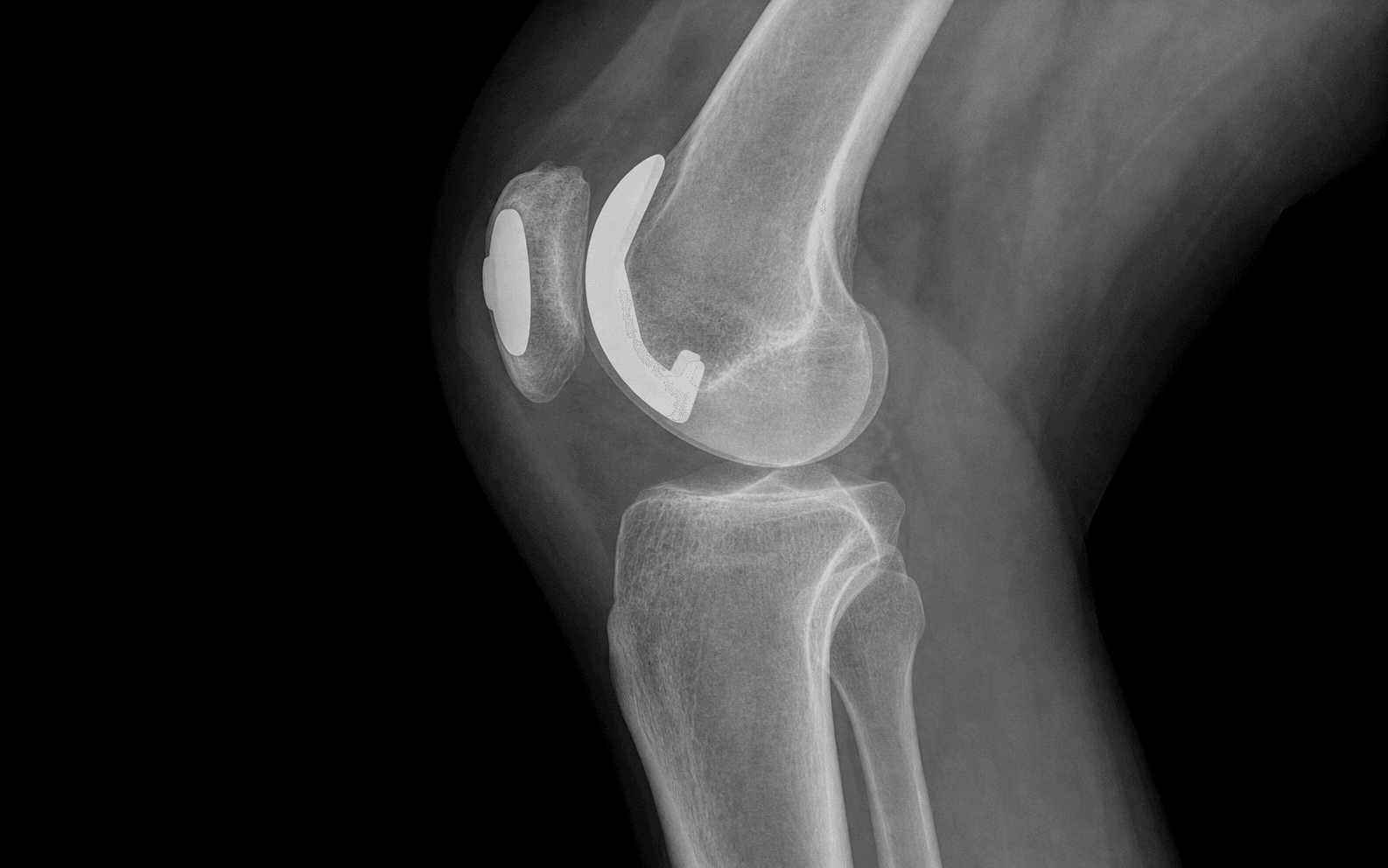 Patellofemoral arthroplasty