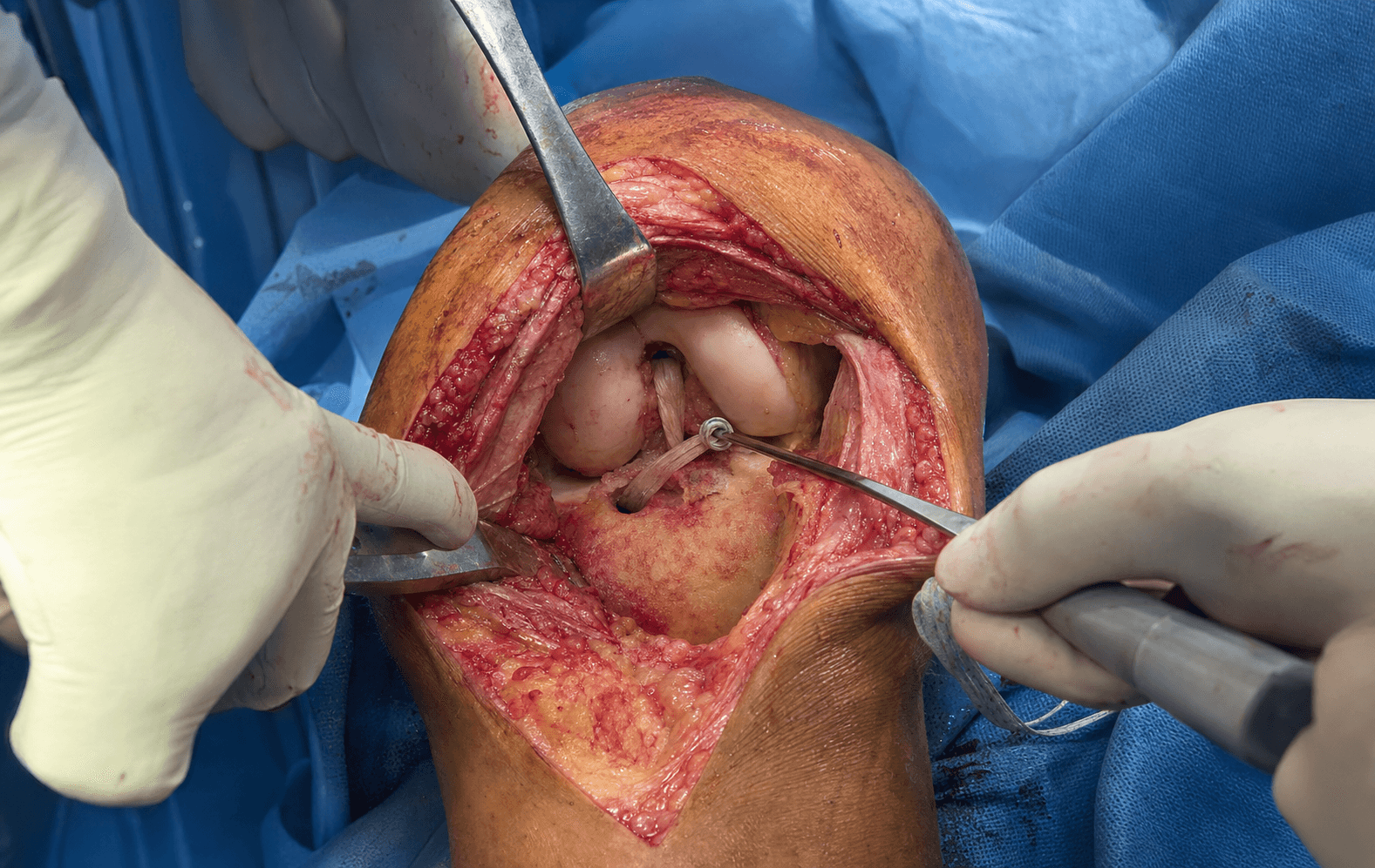 Intra-operative posterior cruciate ligament reconstruction