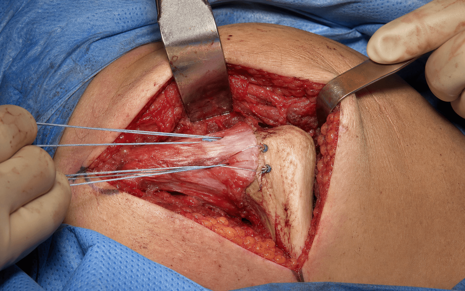 Pectoralis major repair
