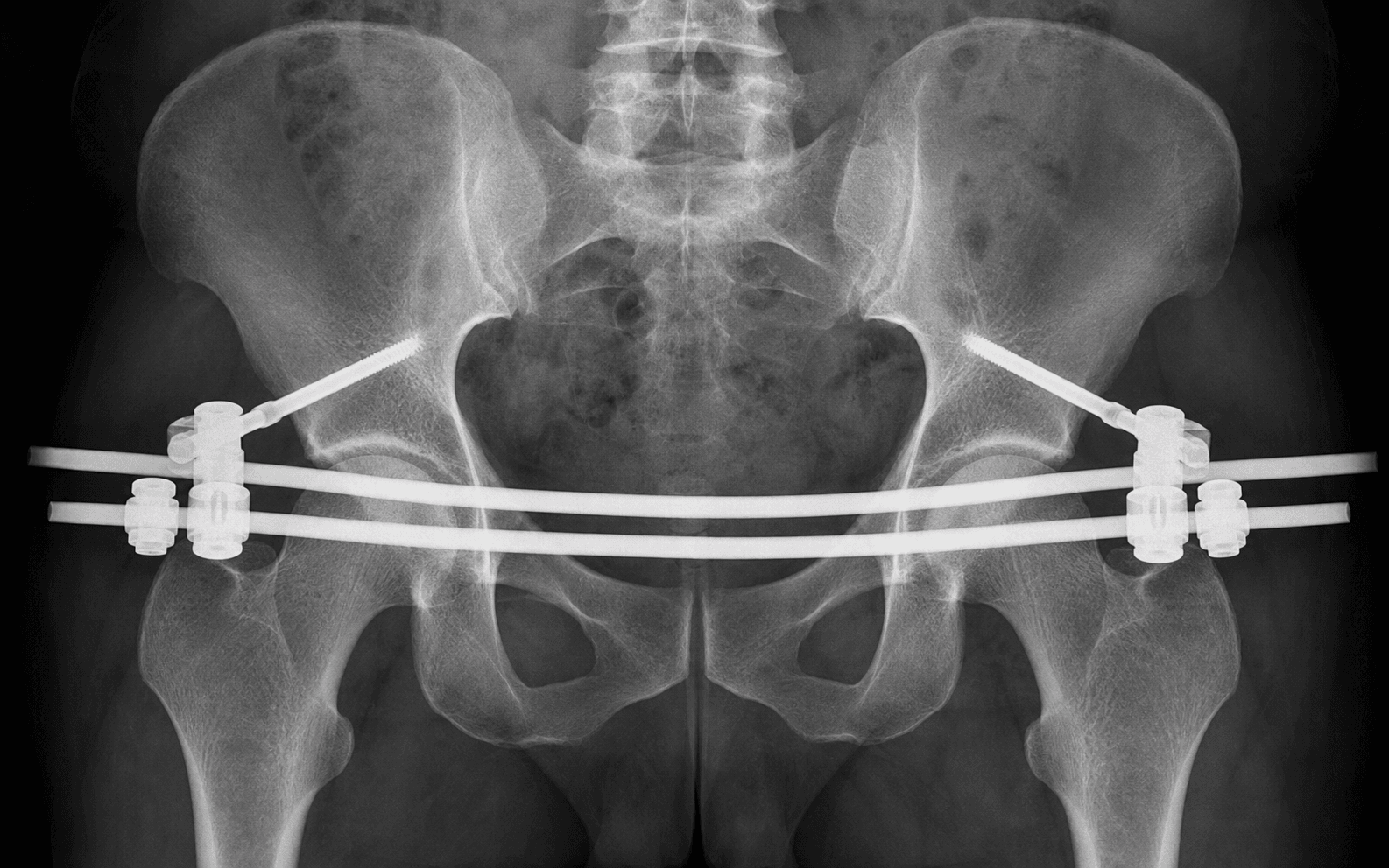 Pelvic ring external fixation