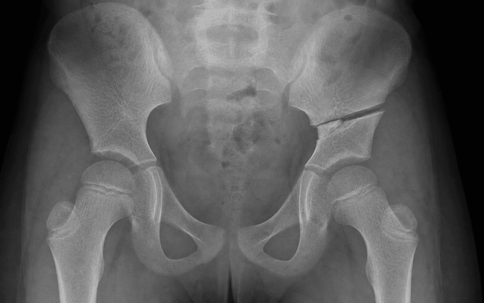Paediatric pelvic radiograph after a Pemberton/Dega acetabuloplasty