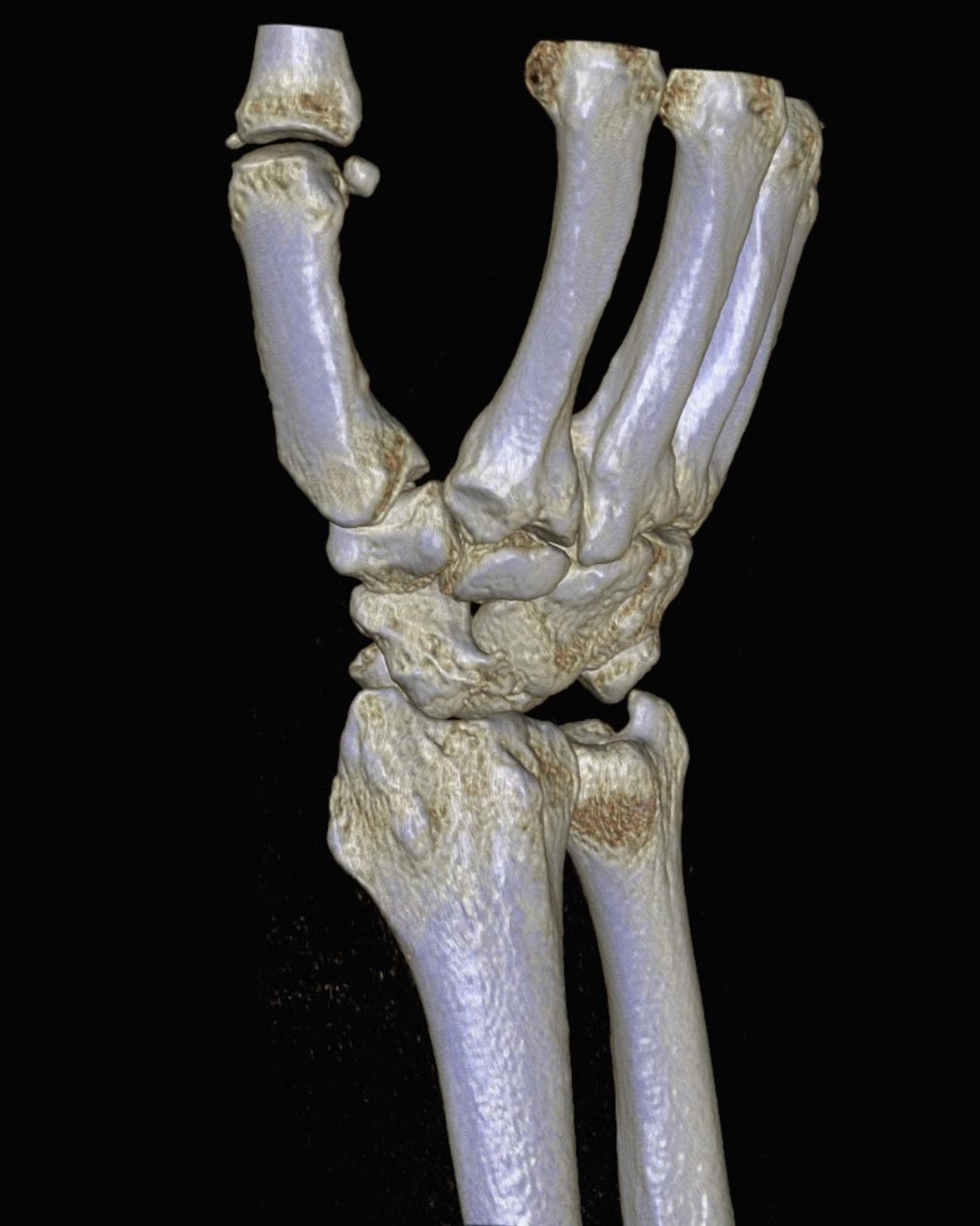3D CT of a perilunate dislocation