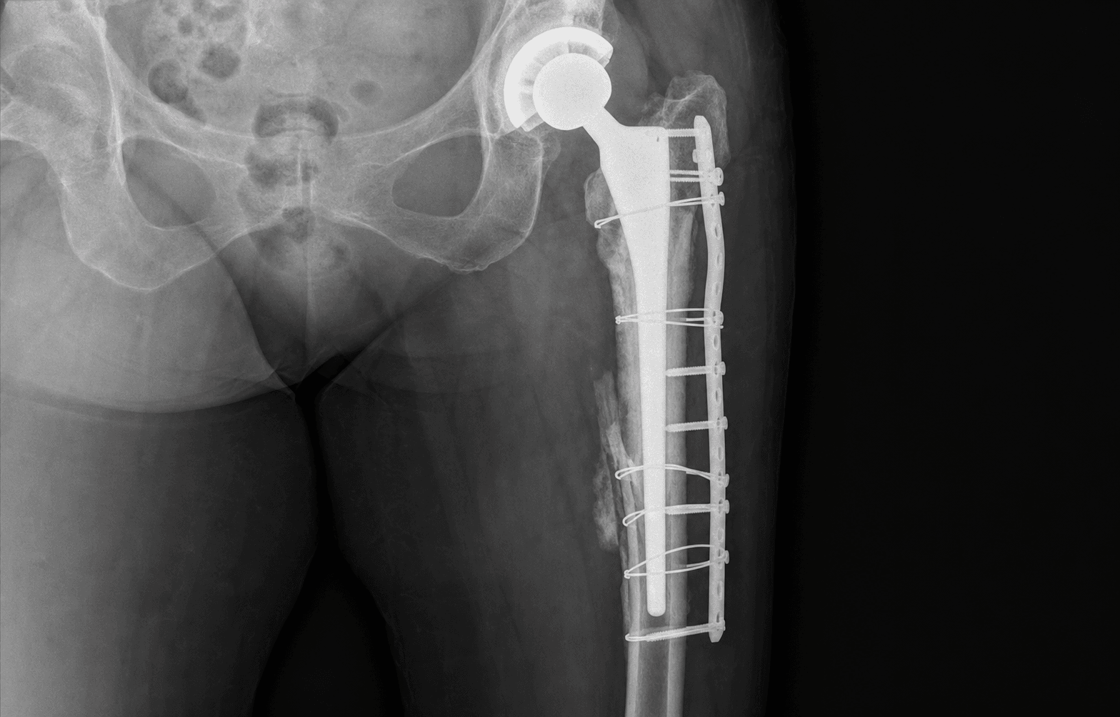 Vancouver B periprosthetic fracture