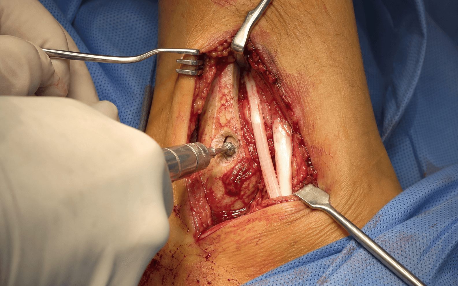 Peroneal groove deepening