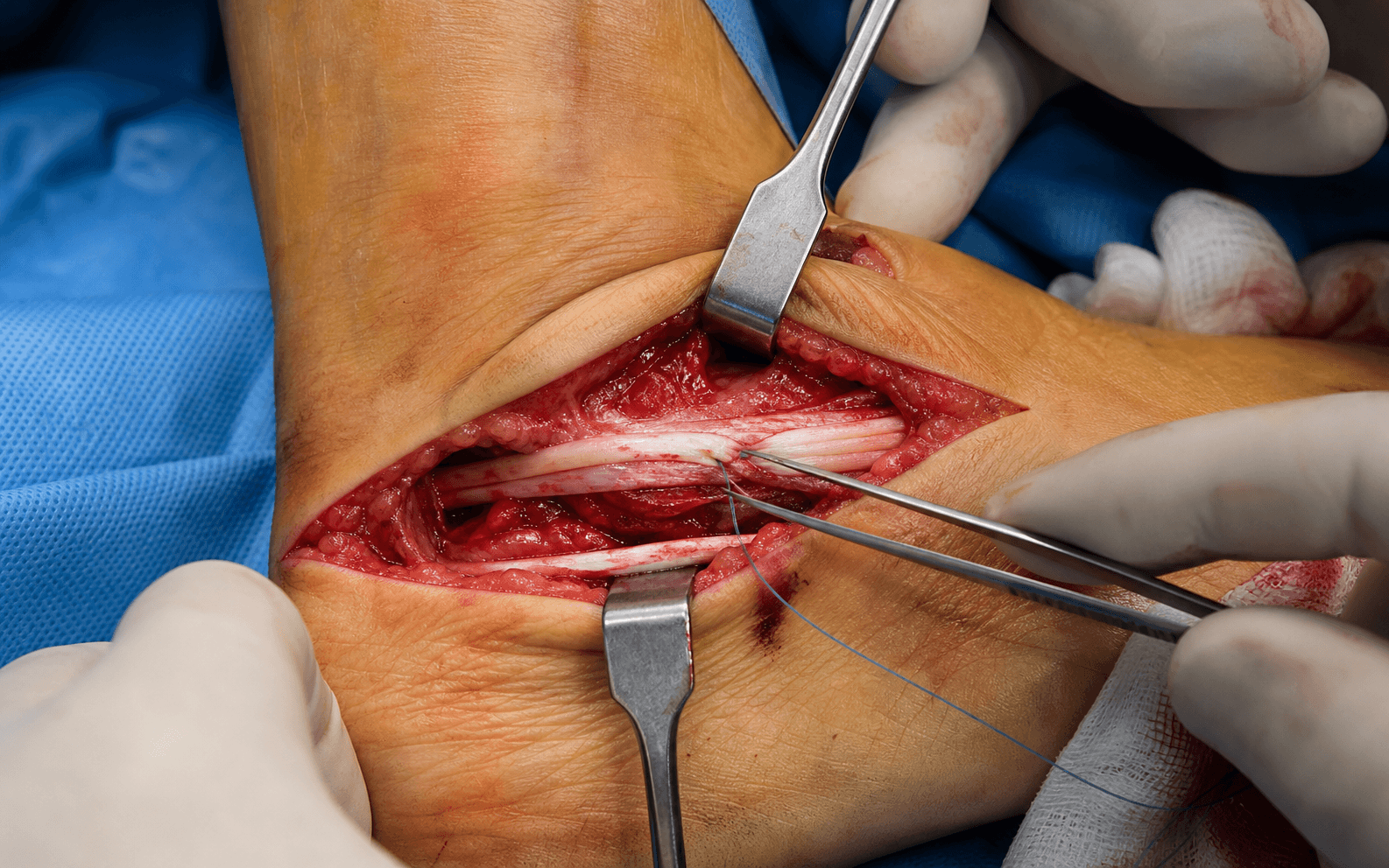 Peroneal tendon repair