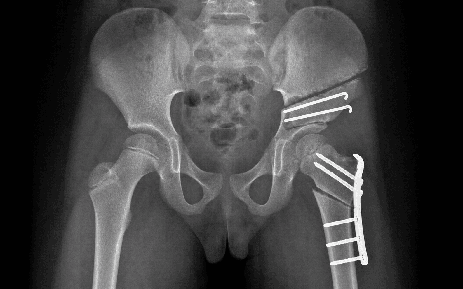 Paediatric pelvic radiograph after Perthes containment osteotomy