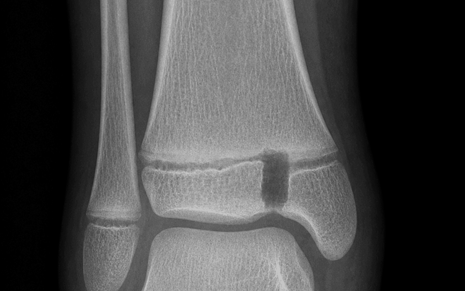 Distal tibial physeal bar